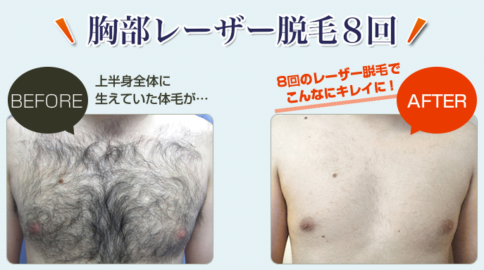 男性の胸部レーザー脱毛を8回した施術前と施術後の比較を画像で紹介しています